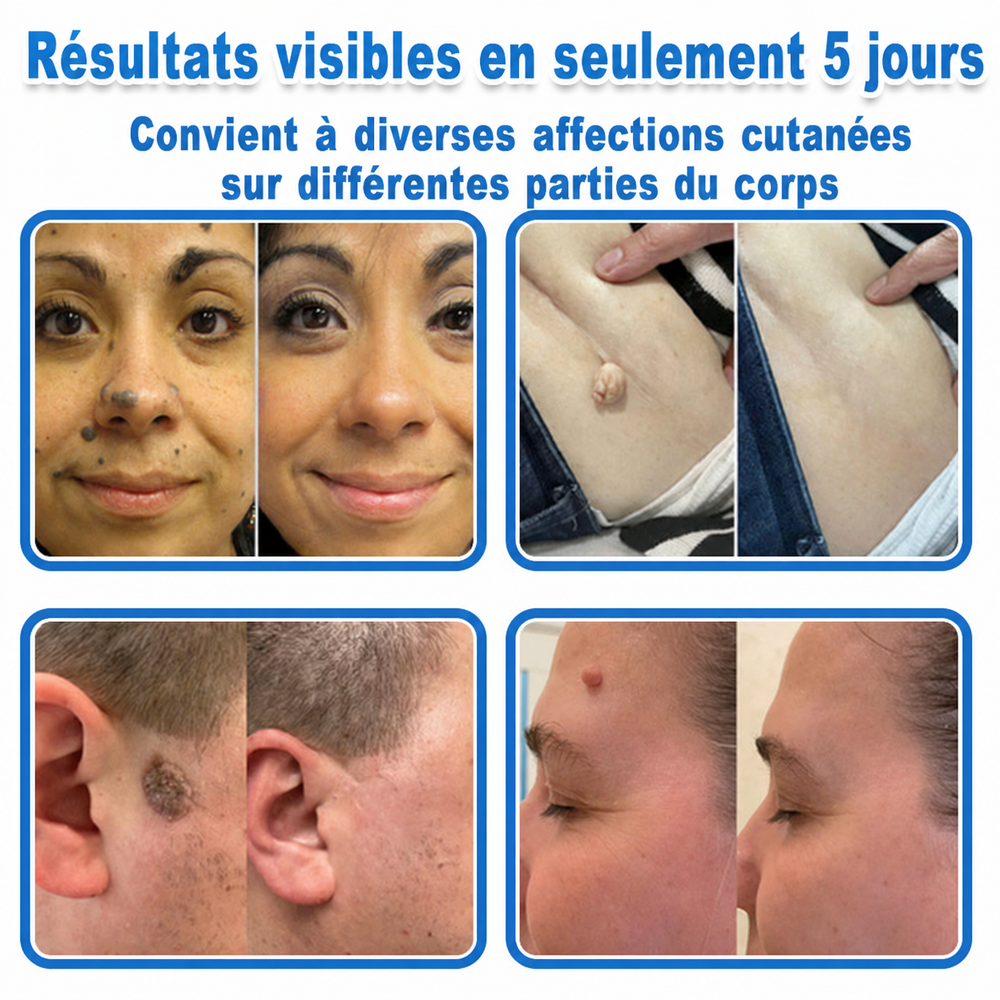 💚Pansements hydrocolloïdes à micro-aiguilles Celsiora® 2-en-1